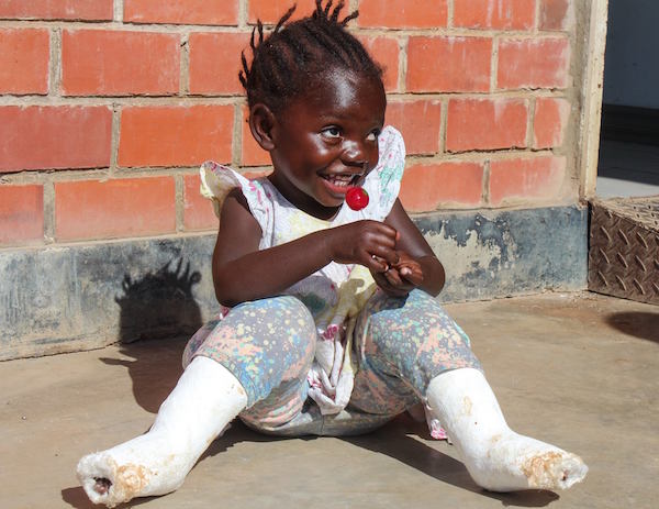 A child recovers from clubfoot treatment. Image courtesy of CURE International.